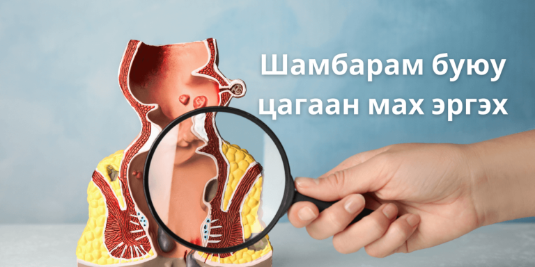 Шамбарамыг та өөрөө эмчилж чадах уу?