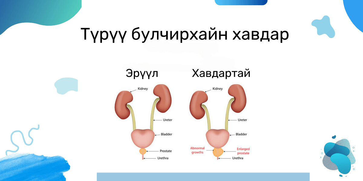 түрүү булчирхай